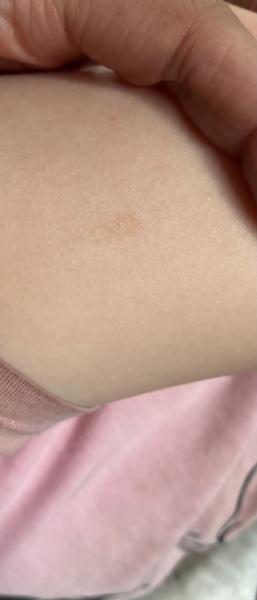 Bild zu Sorge - Haut von Babys und Kindern ✔️ Expertenforum