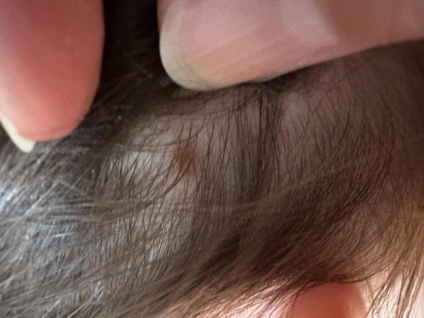 Bild zu Muttermal Kopfhaut - Haut von Babys und Kindern ✔️ Expertenforum