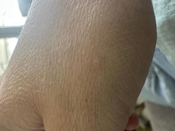 Bild zu Hautveränderung Hand - Haut von Babys und Kindern ✔️ Expertenforum