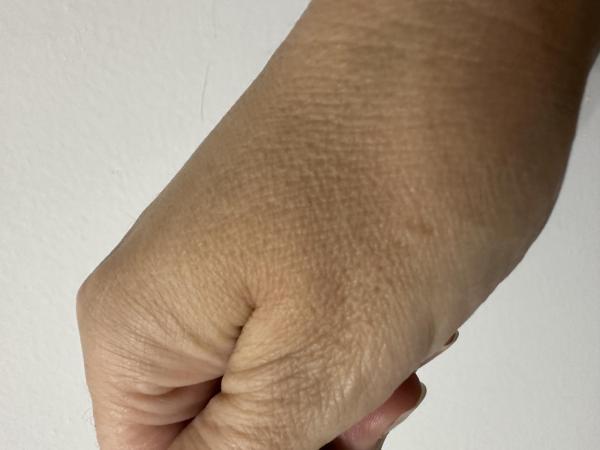 Bild zu Hautveränderung Hand - Haut von Babys und Kindern ✔️ Expertenforum