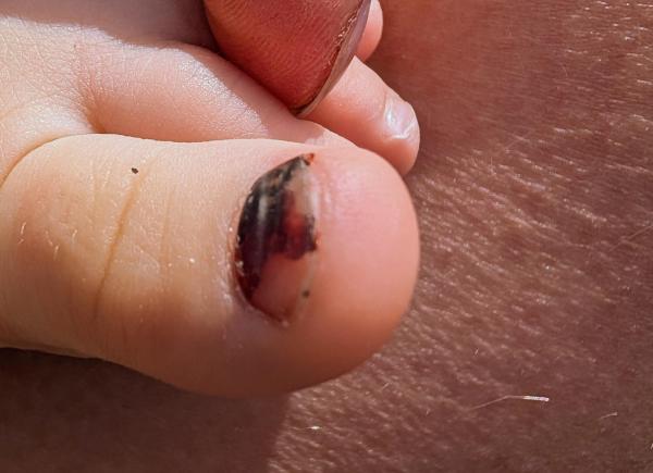 Bild zu Subunguales Hämatom Großzeh - Haut von Babys und Kindern ✔️ Expertenforum