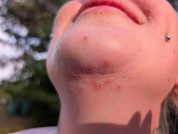 Bild zu Hautausschlag Kinn - Haut von Babys und Kindern ✔️ Expertenforum
