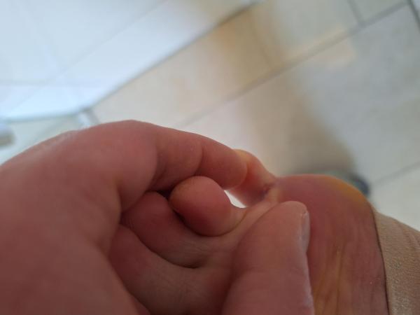 Bild zu Fußpilzbehandlung Schwangerschaft - Haut von Babys und Kindern ✔️ Expertenforum