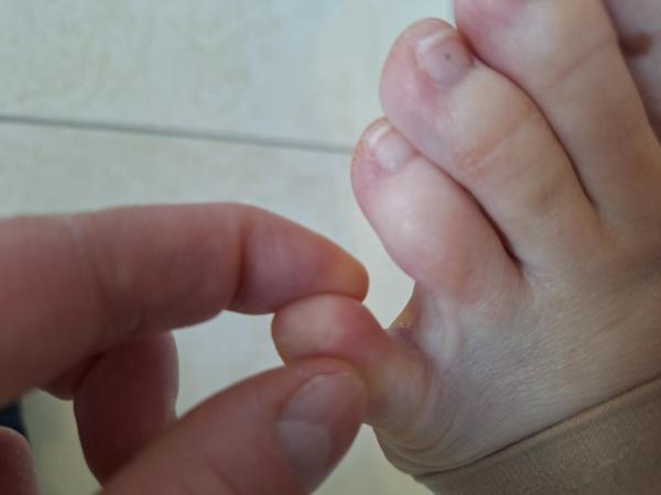 Bild zu Fußpilzbehandlung Schwangerschaft - Haut von Babys und Kindern ✔️ Expertenforum