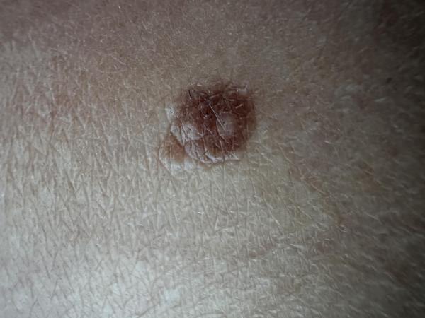 Bild zu Muttermal Knie - Haut von Babys und Kindern ✔️ Expertenforum