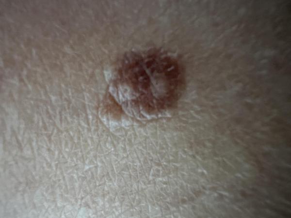 Bild zu Muttermal Knie - Haut von Babys und Kindern ✔️ Expertenforum