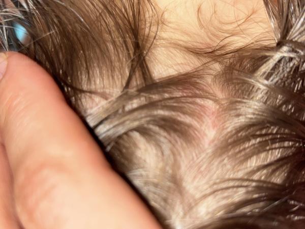 Bild zu Hautausschlag am Hinterkopf - Haut von Babys und Kindern ✔️ Expertenforum