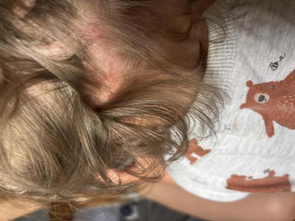 Bild zu Hautausschlag am Hinterkopf - Haut von Babys und Kindern ✔️ Expertenforum
