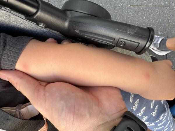 Bild zu Wiederkehrende rote Punkte - Haut von Babys und Kindern ✔️ Expertenforum