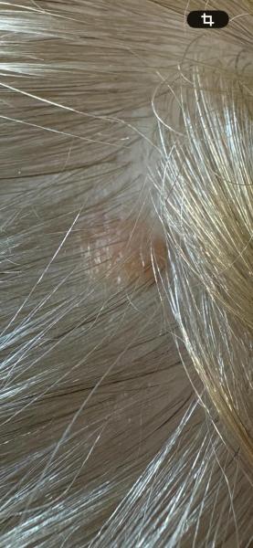 Bild zu Ist das ein Muttermal - Haut von Babys und Kindern ✔️ Expertenforum