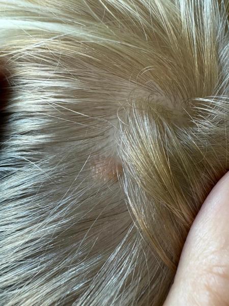 Bild zu Ist das ein Muttermal - Haut von Babys und Kindern ✔️ Expertenforum