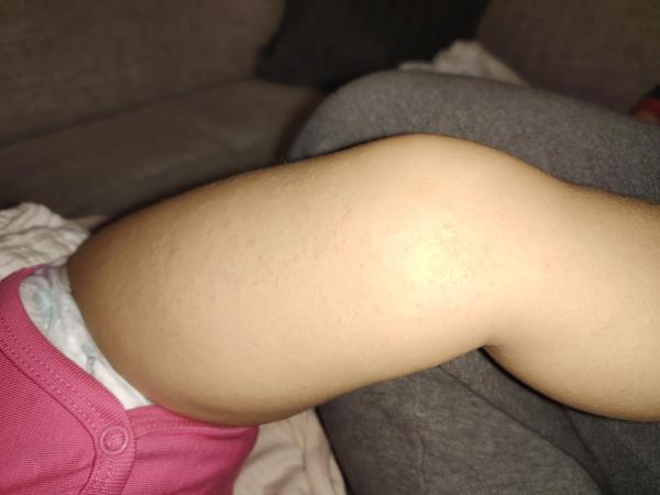 Bild zu Hautausschlag - Haut von Babys und Kindern ✔️ Expertenforum