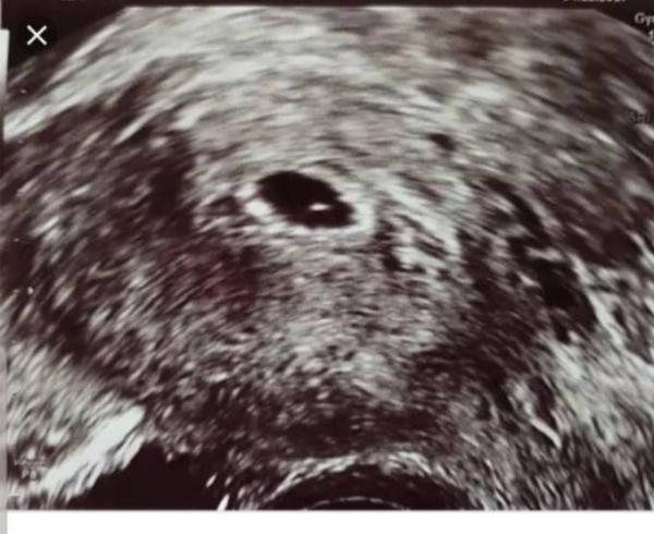 Bild zu 5+1 Embryo zu sehen aber noch kein Dottersack - Schwanger unter 20 - Forum für junge Schwangere und Eltern