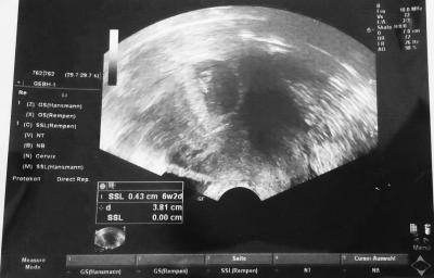 Bild zu Bitte mal schauen ... Bitte! Seht ihr auch die 2. Fruchtblase? - Mehrlinge - für Eltern mit Zwillingen, Drillingen und mehr