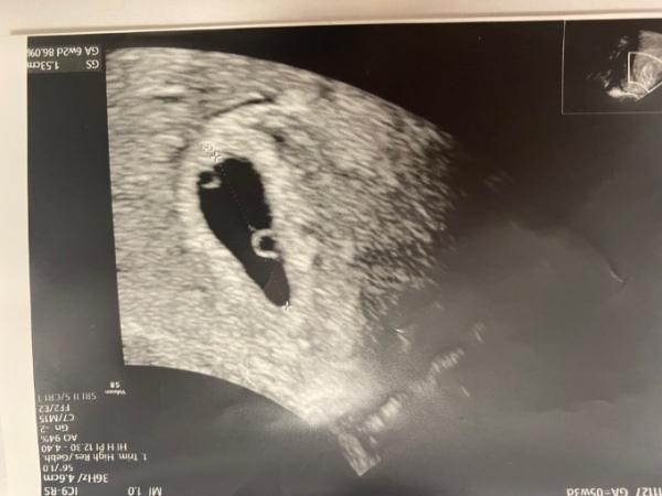 Bild zu 1. US 2 Dottersäcke und im 2. US nur ein Dottersack und Embryo. Bei wem noch? - Mehrlinge - für Eltern mit Zwillingen, Drillingen und mehr