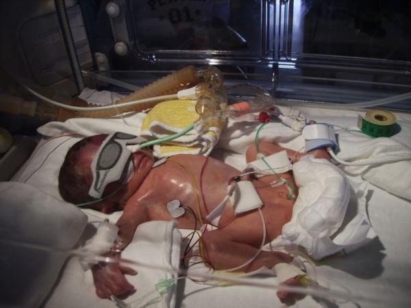 Bild zu Von uns auch mal ein VORHER/NACHHER Bild - Frühchen - für Eltern mit frühgeborenen Babys