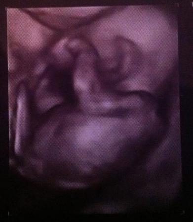 Bild zu Ich stell mich schonmal vor - werde bald dazu gehören :( (Achtung lang) - Frühchen - für Eltern mit frühgeborenen Babys