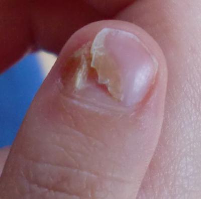 Bild zu Nagelprobleme - Frühchen - für Eltern mit frühgeborenen Babys