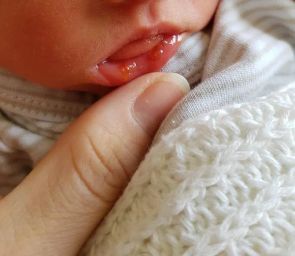 Bild zu Bläschen an der Lippe - Frühchen - für Eltern mit frühgeborenen Babys