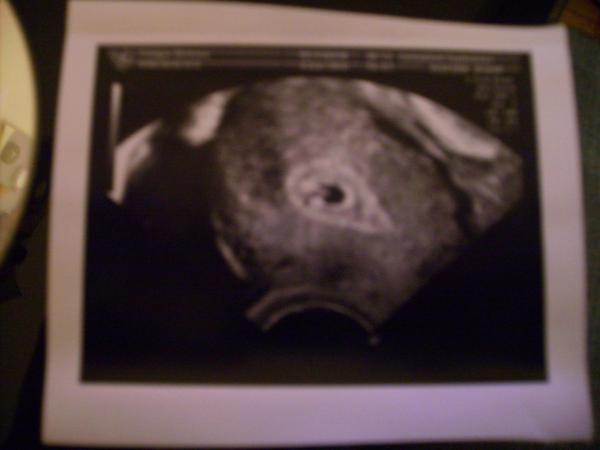 Bild zu Ultraschall bild von Krankenhaus 5woche!!???? - Baby und Job
