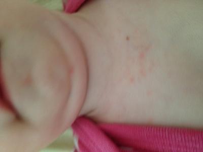 Bild zu Ausschlag? - Der erste Brei - die Beikost