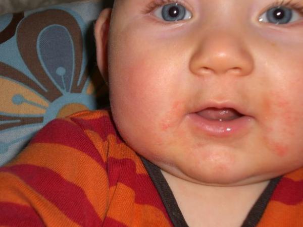 Bild zu Ausschlag um den Mund - Babys 1. Lebensjahr