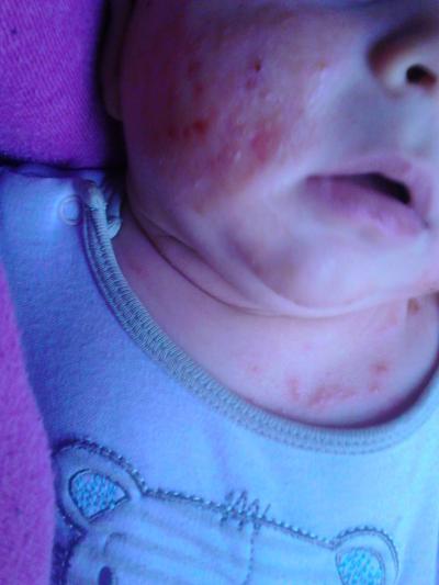 Bild zu ekzem ? - Babys 1. Lebensjahr