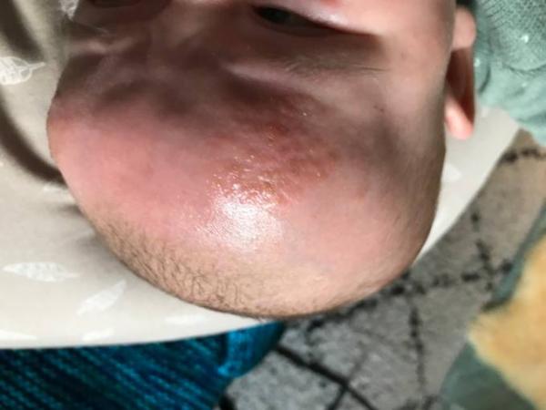 Bild zu Trockene huckelige rote Stellen auf der Stirn. Ausschlag? - Babypflege - so pflegen Sie Ihr Baby richtig