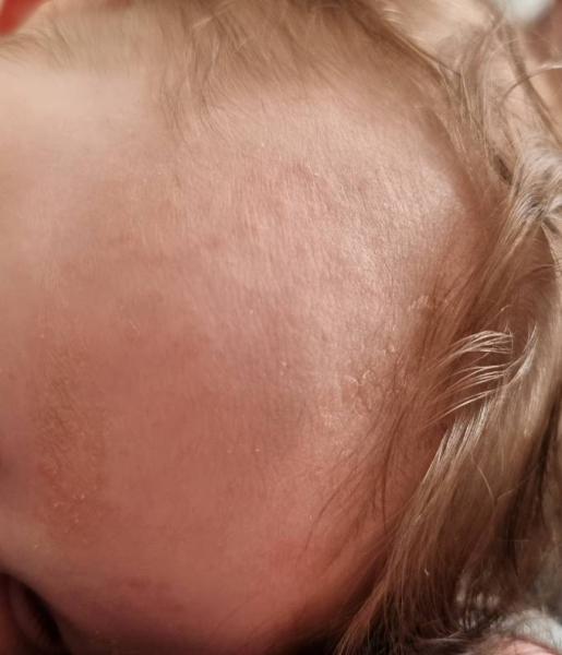 Bild zu Ausschlag, Pickelchen, Schorf, Gneiß? - Babypflege - so pflegen Sie Ihr Baby richtig