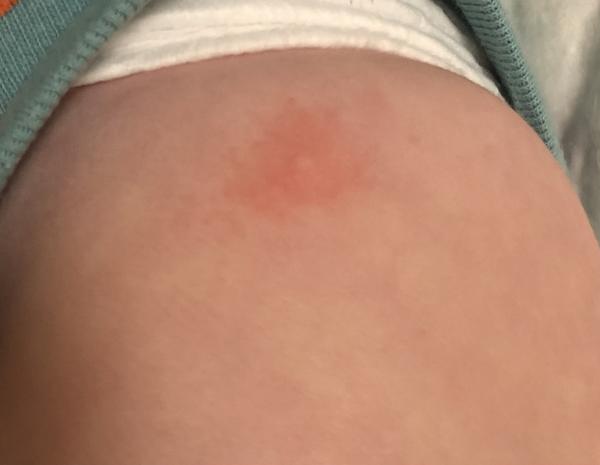 Bild zu Ausschlag / Pickelchen durch Zahnen - Babypflege - so pflegen Sie Ihr Baby richtig