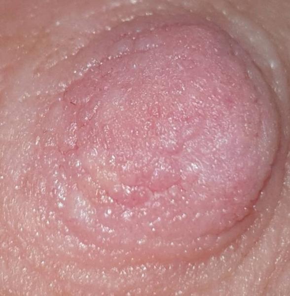 Bild zu Herpes ??? - Stillen - Tipps, Erfahrungen, Austausch für stillende Mütter
