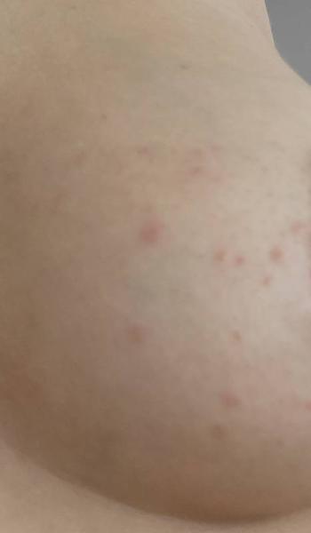 Bild zu Abpumpen/ Ausschlag auf Brust - Stillen - Tipps, Erfahrungen, Austausch für stillende Mütter