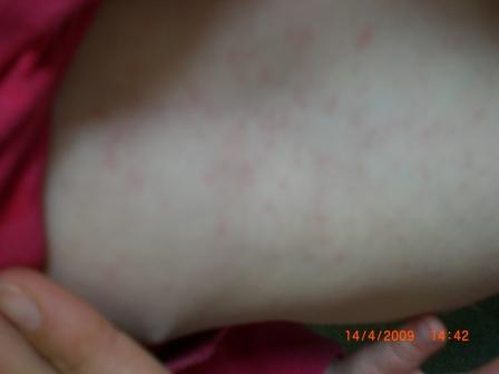 Bild zu Merkwürdiger Ausschlag - Hilfe für chronisch kranke und behinderte Kinder