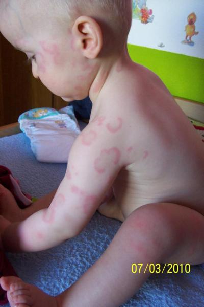 Bild zu Hautausschlag - Hilfe für chronisch kranke und behinderte Kinder