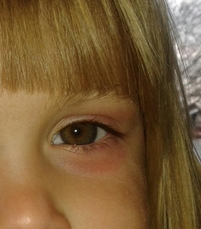 Bild zu Heuschnupfen Kind? - Hilfe für chronisch kranke und behinderte Kinder