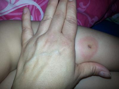 Bild zu Borreliose bei 4jähriger - Hilfe für chronisch kranke und behinderte Kinder