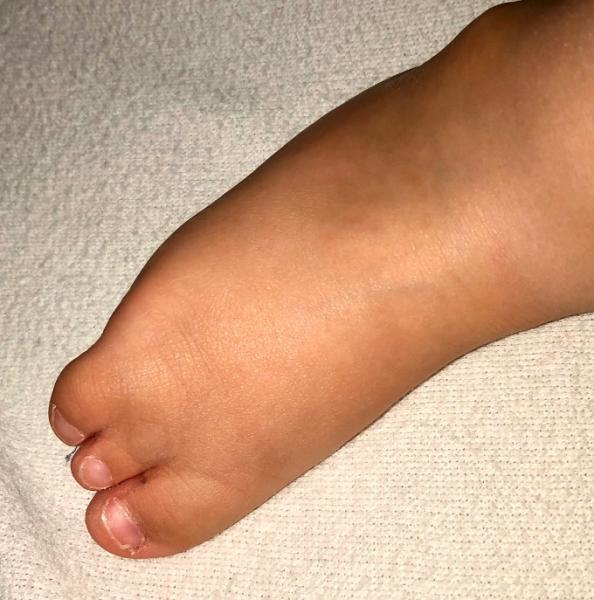 Bild zu Welche Kinderorthopädie mit angeborener Fußfehlbildung - Hilfe für chronisch kranke und behinderte Kinder