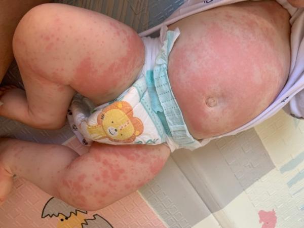 Bild zu Baby starker Ausschlag - Mein Kind ist krank