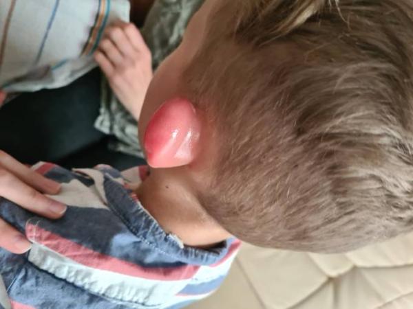 Bild zu Kind 4 Jahre, allergische reaktion - Mein Kind ist krank