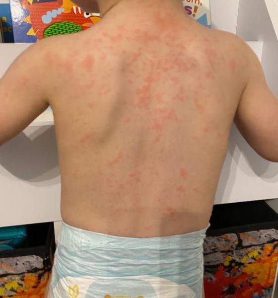 Bild zu 16 Monate - Fiebrig schon seit 1 Woche - Virus - Mein Kind ist krank