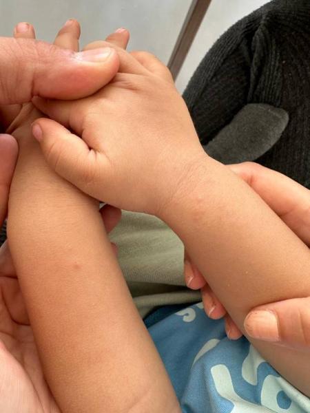 Bild zu Unerklärlicher Ausschlag an den Handgelenken - Mein Kind ist krank