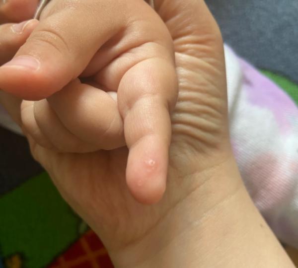 Bild zu Kleine Bläschen an der Hand - Mein Kind ist krank