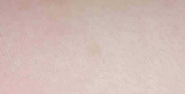 Bild zu Pigmentflecken Baby? - Mein Kind ist krank