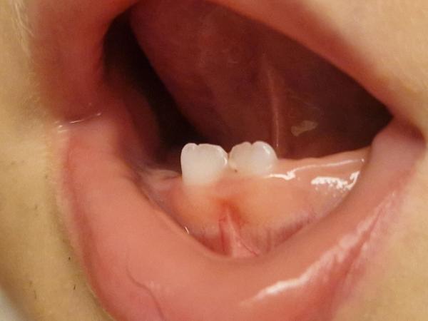 Bild zu Weißer Fleck an Milchzahn plötzlich da - Mein Kind ist krank