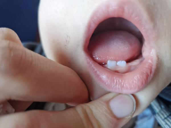 Bild zu Weißer Fleck an Milchzahn plötzlich da - Mein Kind ist krank