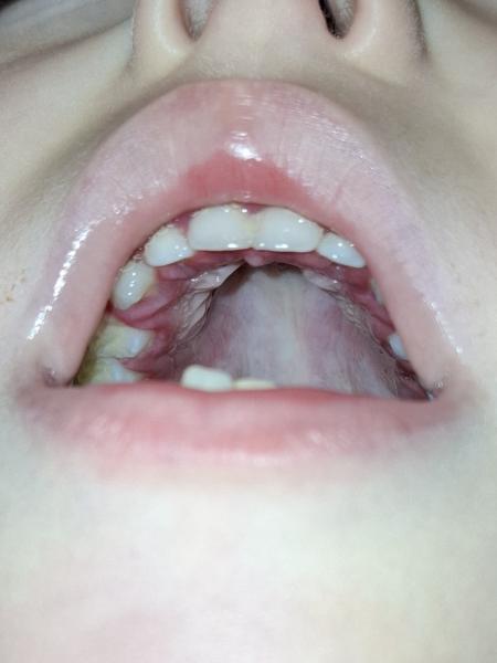 Bild zu Mundfäule oder Soor - Mein Kind ist krank