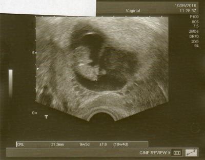 Bild zu Neues vom Löwenbaby und einem doofen Hämatom - Schwanger mit 35 plus - Forum