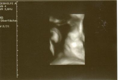 Bild zu Nun Querlage, Doppler-Ergebnis, 3 D - Bilder - Schwanger mit 35 plus - Forum