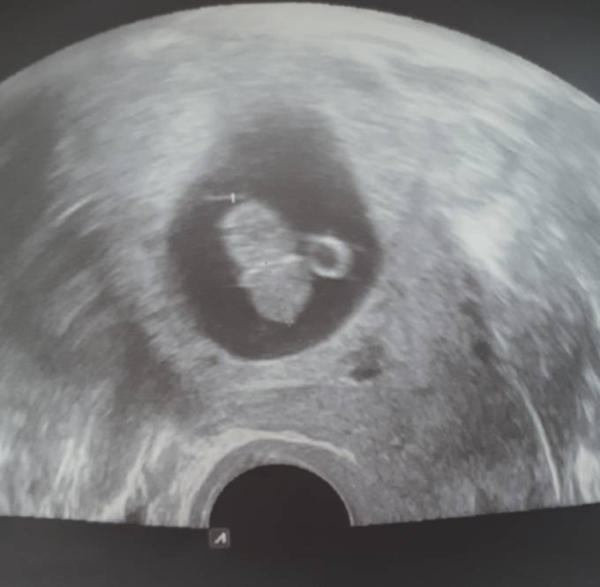 Bild zu Gestern Fa gewesen und glücklich ❤️ - Schwanger mit 35 plus - Forum