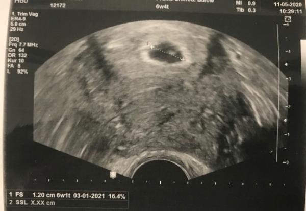 Bild zu 1. Ultraschall -alles ok? - Schwanger mit 35 plus - Forum
